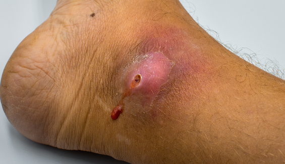 wound infections