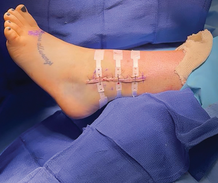 Proper Wound Care Protocols